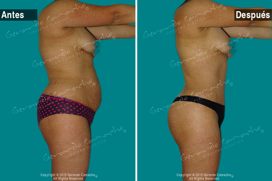 Transformación abdominal antes y después de abdominoplastia en Bogotá